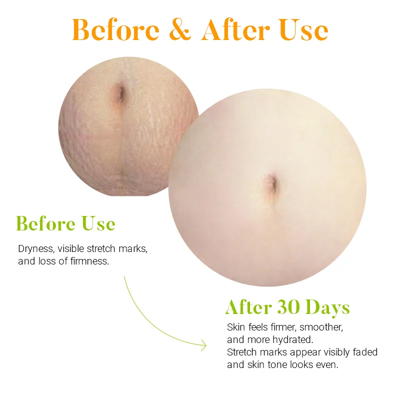 Comparison of skin before and after 30 days showing improvement in hydration, firmness, and reduction of stretch marks.